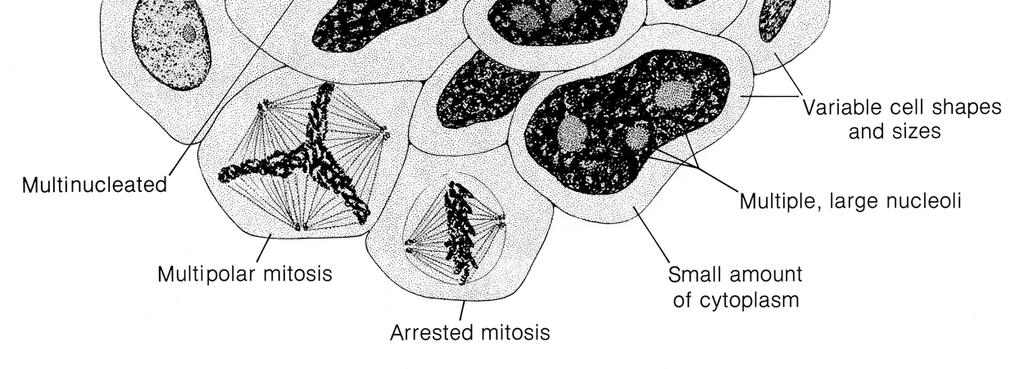 Bizarr sejtalakok Multinukleáció, tumoros óriássejtek Nagy számú, sokszor bizarr mitotikus alakok Invázió 1.