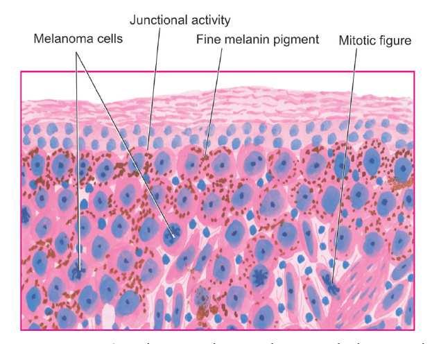 Melanoma basal cell carcinoma CARCINOGENEZIS CARCINOGENEZIS