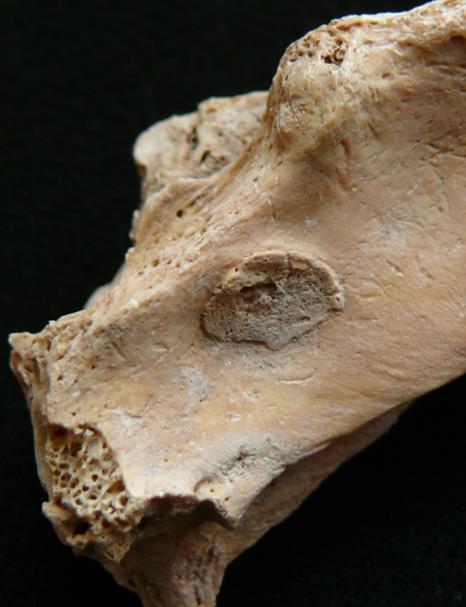 Árpád-kor Az elsődleges molekuláris vizsgálatokba egy egyén humerus-át és femur-ját vontuk be, annak igazolására, hogy megerősítsük a Mycobacteriális-fertőzés jelenlétét ebben az Árpád-kori temetőben.
