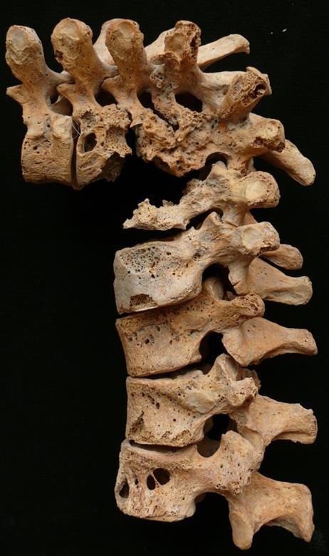 19. ábra: A Győr-Pósdomb lelőhelyről (187. sír Adultus-Maturus, férfi) előkerült Pott-gibbus-os eset (Pósa et al, 2014).