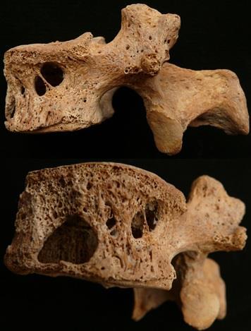 20. ábra: Spondylitis tuberculosa tbc-fertőzés okozta csigolyatest-pusztulás (Győr-Pósdomb lelőhely, 187. sír, Adultus-Maturus, férfi) (Pósa et al, 2014).