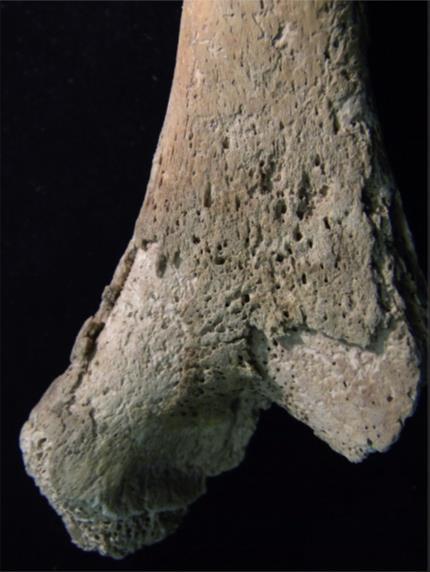 24. ábra: Osteitis, periostitis és feltételezhető ízületi destrukció nyomai egy ifjúkorú (Juv.) egyén jobb humerus distalis részén (Bácsalmás-Óalmás, 391-es sír) (Pósa et al, 2015a).