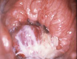 Hüvelytükrözés Külső méhszáj - súlyos endometritis látható gennyes