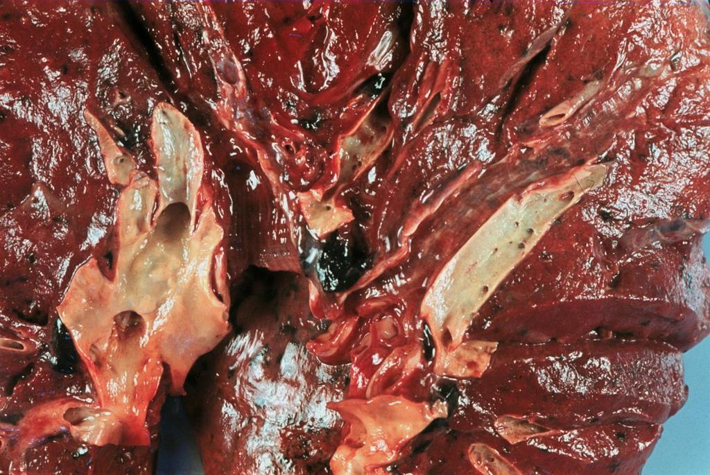 Induratio brunea pulmonum - a tüdő barna keményedése; sec.