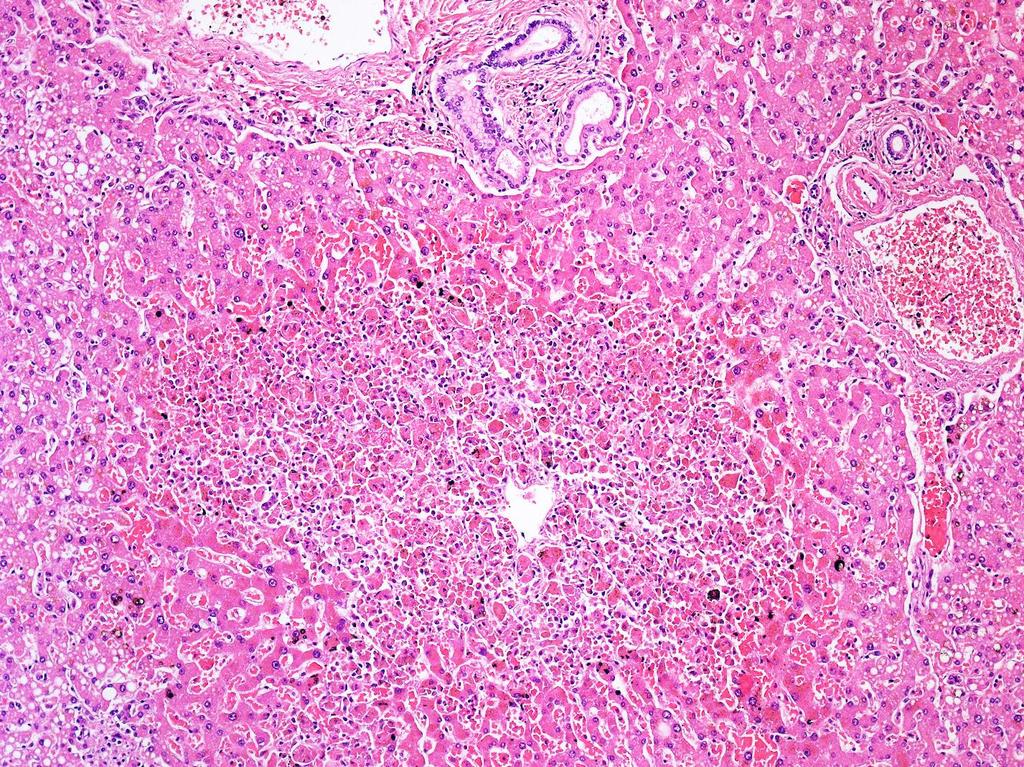 Centrális haemorrhagiás necrosis