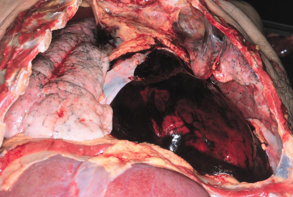 Haemopericardium