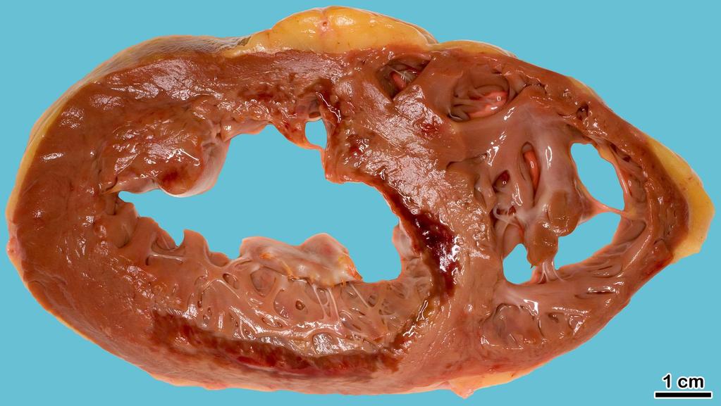 Reperfusiós vérzéses elhalás anteroseptalisan és a hátulsó falon (a coronariatágításra az