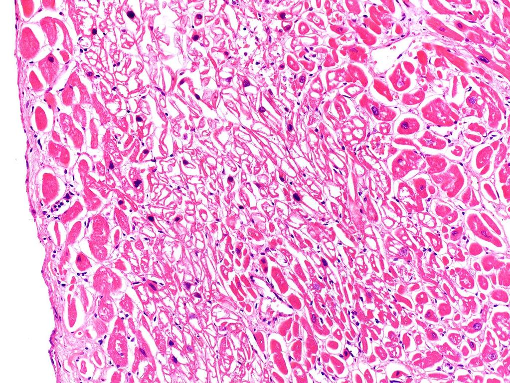 Endocardium Hypoxiás myocytolysis: hólyagos