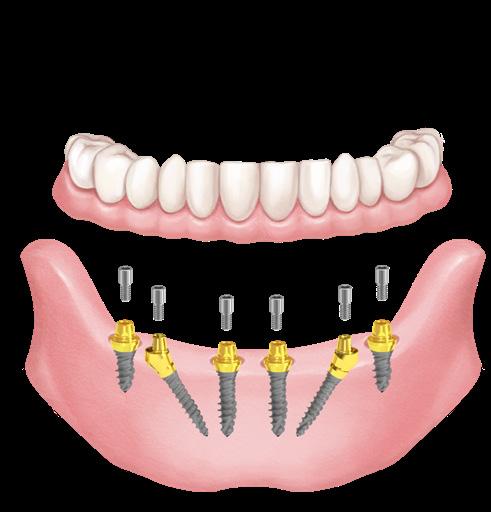 Alkalmazás 51 All-on-4 és All-on-6 - előnyös megoldások vékony implantátumokkal All-on-4 a gazdaságos megoldás A vékony BioDiamond mini implantátumok is alkalmasak All-on-4 megoldással, nagy