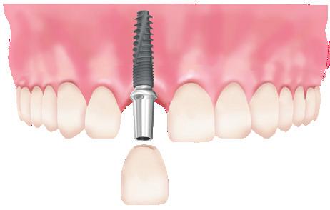 16 CORTILOG Implant System A CORTILOG alkalmazási területei Egy foghiány esetén Ilyenkor egy fog pótlásához nem