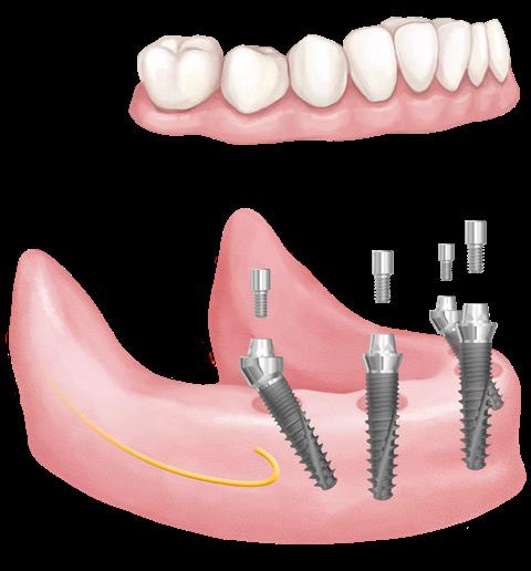 A kezelési idők rövidebbek és a költségek alacsonyabbak lehetnek a hagyományos implantátumkezelési módokhoz képest.