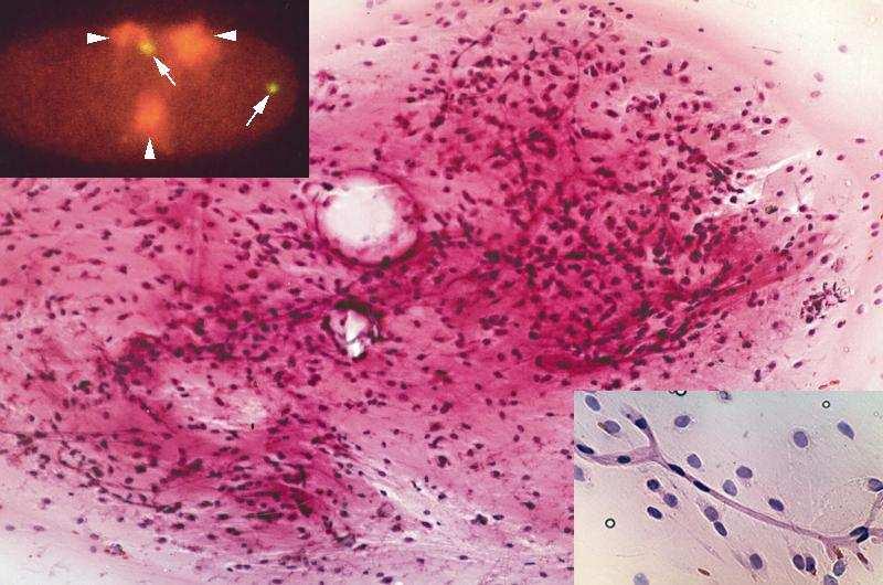 - 23-1. Táblázat A tumorok pontos hisztogenetikai eredettel csoport klinikopatológiai jellemzői Cit. diagnosis Kor,nem Anatómiai lok. DI PI FISH Immunocytokémia Histopatológia 1. Myxoid liposc.