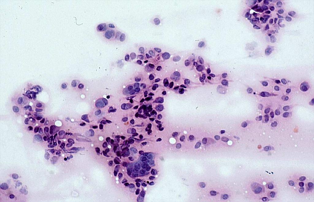 mononukleáris és többmagvú osteoclast típusú óriássejtekkel.