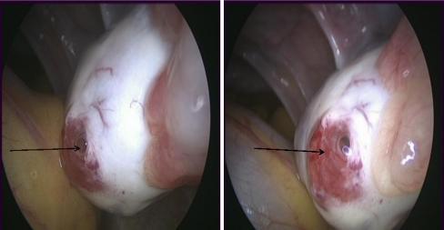 Ovuláci ció előtti ovarium laparoscopos képe: k a repedő folliculus fehér, kissé kidomborítja a