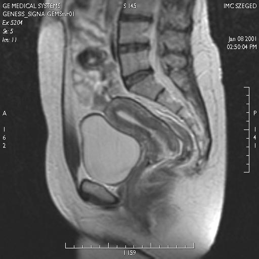 Női i kismedencei szervek MRI