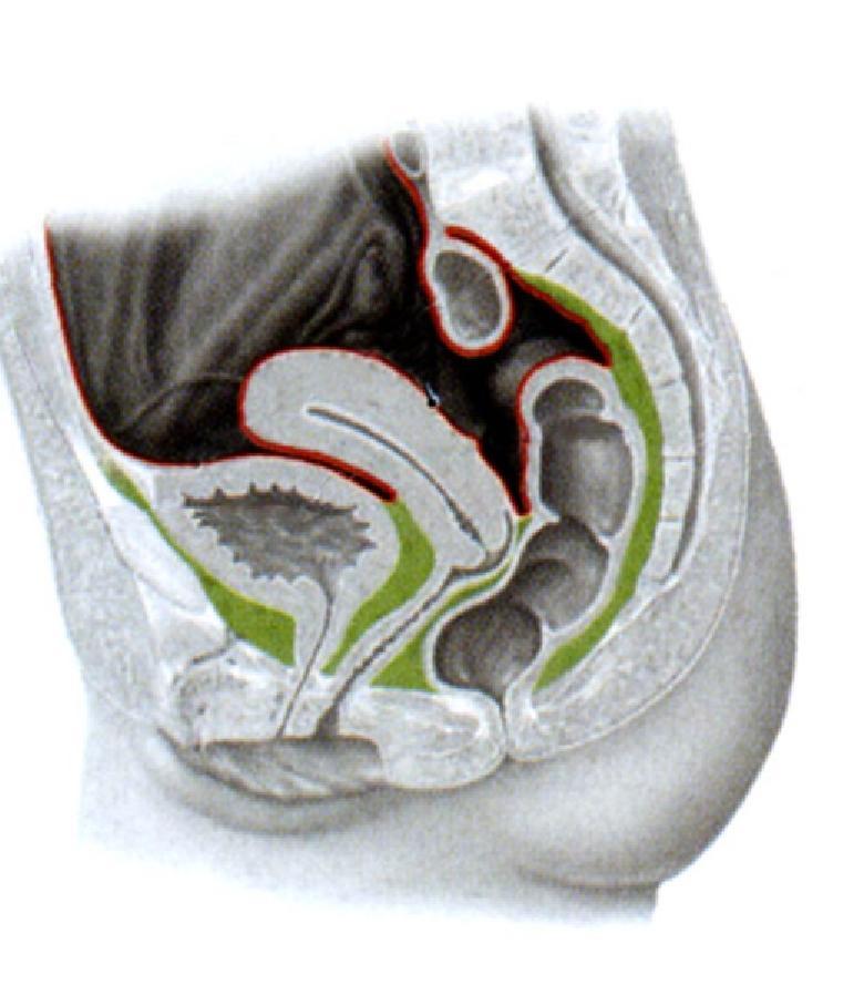 Uterus és s vagina helyzete a kismedencében Anteflexio (a cervix és s a corpus tengelye szöget zár z r be -1).