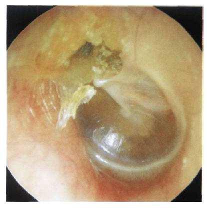 otitis media -