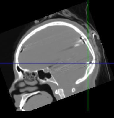Subduralis elektróda lokalizáció CT