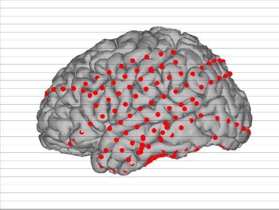 Subduralis elektróda lokalizáció Kortikális felszíni rekonstrukció külön