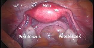 OC és petefészekrák 45 epidemiológiai vizsgálat 23 257 petefészekrákos nő, 87 303 kontroll nő Átlagos relative risk (RR): 0,73 Az OC szedés hosszától függ: 0,78, ha 2,4 évig 0,64, ha 6,8 évig 0,56,