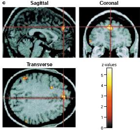 (Eyes Test) Superior temporalis