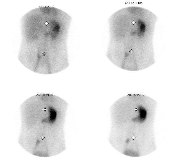 Radiofarmakon: 99mTc-pertechnetát i.v. Gyomor mucosa kiválasztja, az ectopiás is!