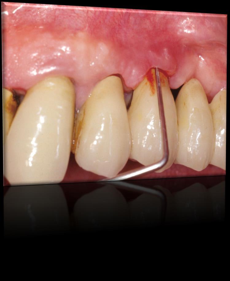 Vizsgálatok/klinikai kép 0,25N erejű szondázás, 4mm< tasak vérzés diagnózis erősebb gyulladásos válaszreakció, apicalis irányú terjedés gingiva hyperplasia Divinyi T. (2007). Orális implantológia.