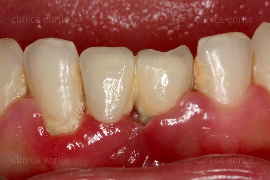(tetraciklinek) sebészi kezelés: hyperplasia, granulatios szövet eltávolítás Divinyi T. (2007). Orális implantológia.