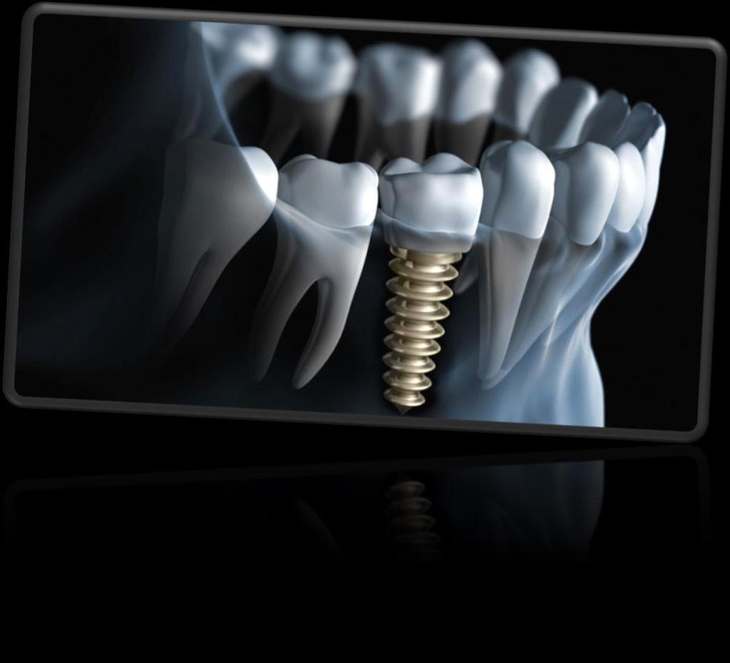 A fogászati implantáció fogalma és jelentősége A fogászati implantáció során az állcsontokba műtéti úton dentális implantátumok kerülnek beültetésre, melyek egyes fogak hiányának pótlására, illetve