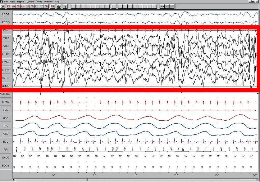 ElektroEncefaloGram Agykutatás - Skalpról (fejtetőről) elvezetett elektromos aktivitás - Komplex, több komponensből álló