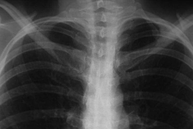 Thoracic Outlet Syndrome (TOS) - pathophysiologia Williams TK et al.