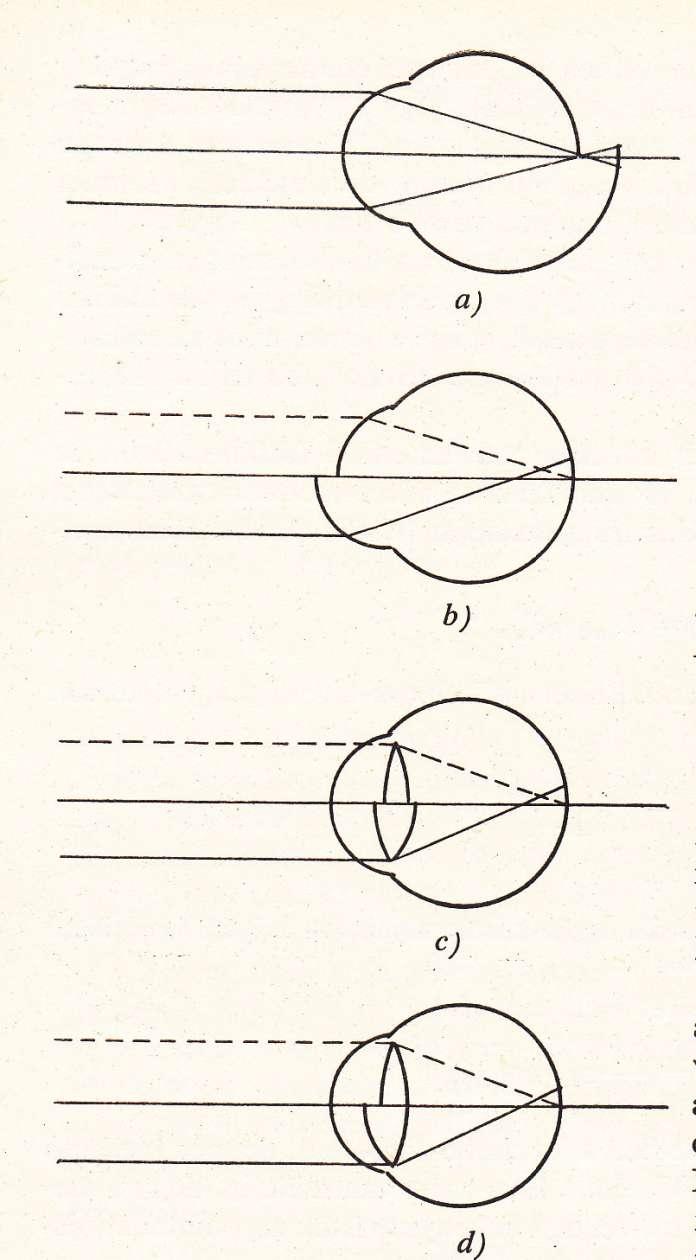 A myopia formái Tengelyi myopia: A szem tengelye hosszabb, mint ami az emmetropiás szemnek megfelelne (pl a szem megállíthatatlan növekedése miatt) Törési myopia: A szem törőereje nagyobb a