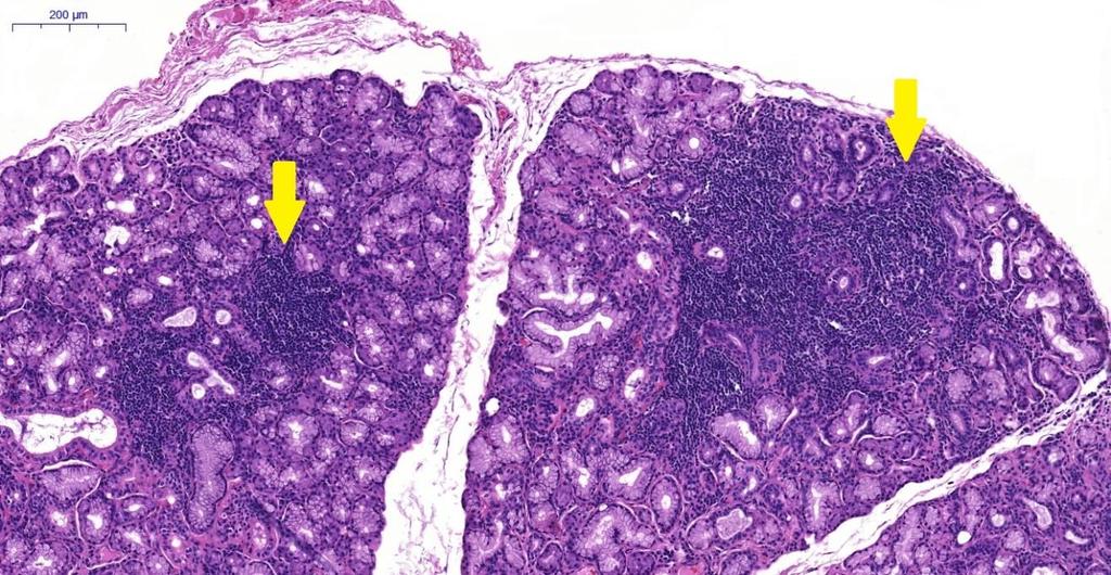 Kisnyálmirigyekben előforduló hisztopatológiai elváltozások Gyulladás és lymphoepithelialis lézió SS szempontjából a mirigyekben előforduló gyulladás gradálása elsődleges jelentőséggel bír.