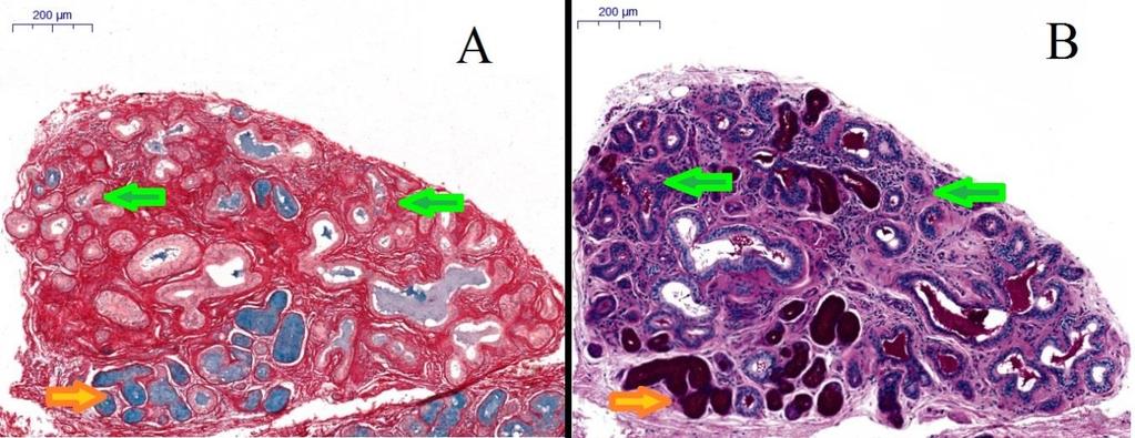 Acinus vesztés és ductalis hám metaplasia A végkamrák pusztulása (acinus vesztés, atrophia ) a mucint termelő sejtek eltűnésével és a ductalis, osztódásra képes hámsejtek proliferációjával jár
