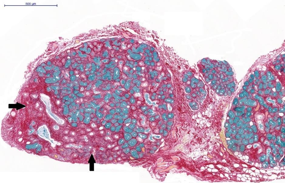 6. kép. Partialis lobularis fibrosis (fekete nyilak) APS festéssel. A jelölt területeken acinus vesztés és ductalis hámmetaplasia látható.