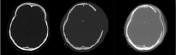 III.2 Páciens-specifikus modell A Pécsi Tudományegyetem Idegsebészeti Klinika két beteg kraniektómia utáni CT felvételeit bocsájtotta rendelkezésünkre.