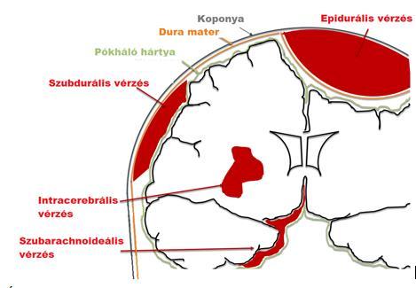 II.1.3 Ábra: A koponyán belül fellépő vérzések fajtái [3] II.2.