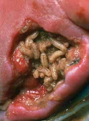 Az antibiotikumok felfedezése után az eljárás hirtelen feledésbe merült, de modern változata, a szigorúan szabályozott keretek között szaporított Lucilia sericata lárvákkal egyes források szerint