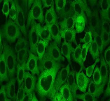 Myositis asszociált antitestek (MAA): Anti-PM-Scl 4-12% PM/DM/Scleroderma overlap Anti-Ku 1-3% PM, DM, 9-19%