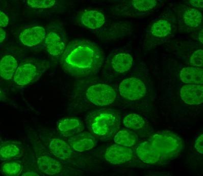 6. P-Ribosoma antitest: Target antigén a ribosoma-komplex fehérjéi (P0, P1, P2) SLE diagnosztikai