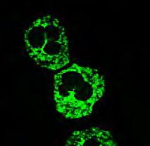 Pozitivitása a betegség aktivitásával, lupus nephritis és májérintettséggel korrelál P-Ribosoma