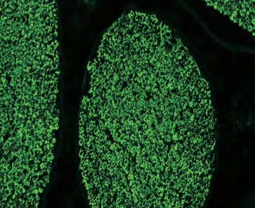 Neurológiai betegségekre jellemző antitestek: Gangliozid és glycoprotein-saccharidok elleni antitestek multifokális motoros neuropathiákban (GM1 antitest), Guillain-Barre szindrómában (GM1 és GD1a