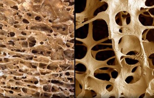 Biszfoszfonátok Antireszorptív szerek Osteolysissel járó malignus és benignus kórképek terápiájában (kemoterápiás protokoll)