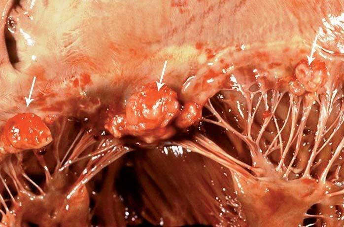 Magyar Fogorvos 2016/6 287 mikrobák mennyiségével. Kimutatták, hogy foghúzás után az esetek 100%-ában létrejött bacteriaemia, még gingivitis során csupán 10% volt az előfordulási arány.