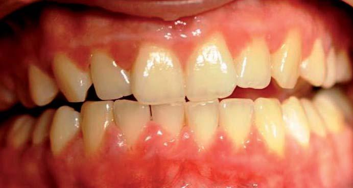 periodontitis kezelése cukorbetegséggel