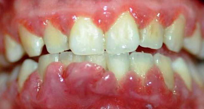 periodontitis cukorbetegséggel