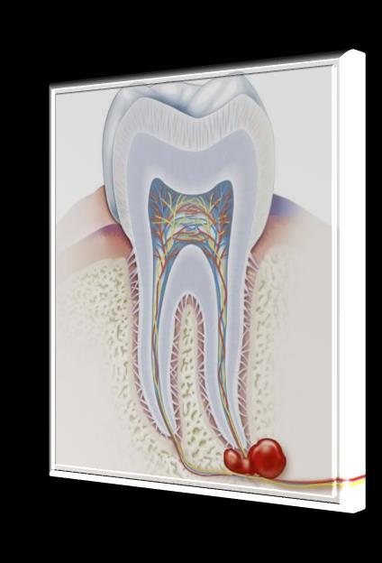 PULPITIS GANGRAENA PULPAE periodontitis