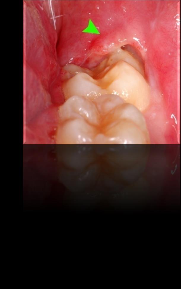 PERICORONITIS