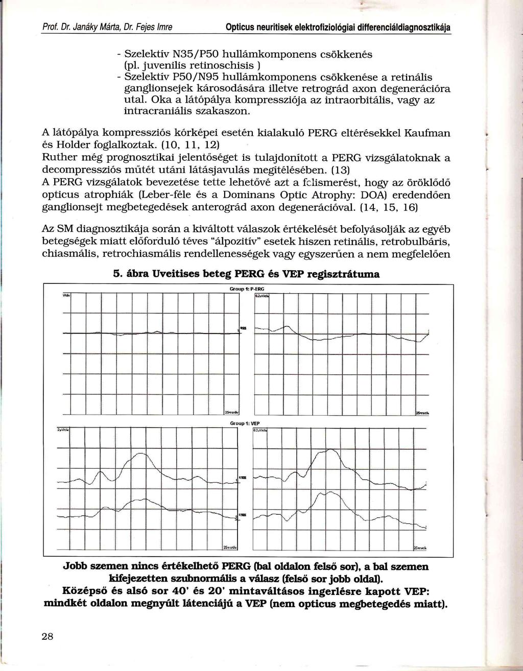 Jf Prof. Dr. Janáky Márta, Dr. Fejes Imre Opticus neuritisek elektrofiziológiai differenciáldiagnosztikája - Szelektív N35/P50 hullámkomponens csökkenés (pl.