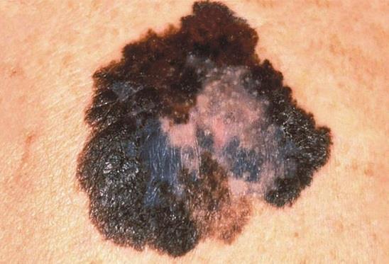 DAGANATOS BETEGSÉGEK - A megnövekedett UV sugárzás hatással van a bőr jó- és rosszindulatú patológiai folyamataira